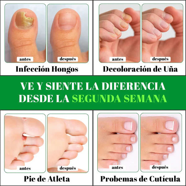 TERBINAFINA - ELIMINA LOS HONGOS DE LAS UÑAS 2x 99 SOLES